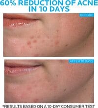 La Roche Posay Effaclar Duo Dual Action Acne Spot Treatment Cream With Benzoyl Peroxide Acne Treatment, Blemish Cream For Acne And Blackheads, Safe For Sensitive Skin